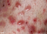 pretibial_dominant_dystrophic_epidermolysis_bullosa
