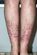 pretibial_dominant_dystrophic_epidermolysis_bullosa