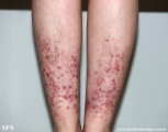 pretibial_dominant_dystrophic_epidermolysis_bullosa