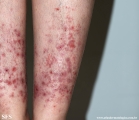 pretibial_dominant_dystrophic_epidermolysis_bullosa