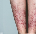 pretibial_dominant_dystrophic_epidermolysis_bullosa