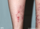pretibial_dominant_dystrophic_epidermolysis_bullosa