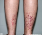 pretibial_dominant_dystrophic_epidermolysis_bullosa