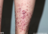 pretibial_dominant_dystrophic_epidermolysis_bullosa