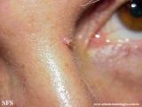inverted follicular keratosis