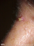 inverted follicular keratosis