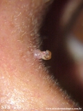 inverted follicular keratosis