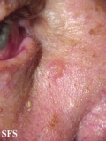 inverted follicular keratosis