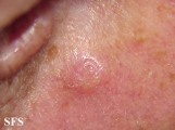 inverted follicular keratosis
