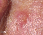 inverted follicular keratosis