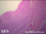 langerhans cell histiocytosis