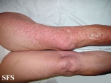 leiomyoma-multiple cutaneous leiomyomas