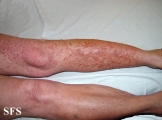 leiomyoma-multiple cutaneous leiomyomas