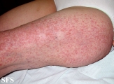 leiomyoma-multiple cutaneous leiomyomas