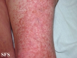 leiomyoma-multiple cutaneous leiomyomas