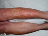 leiomyoma-multiple cutaneous leiomyomas