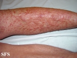 leiomyoma-multiple cutaneous leiomyomas