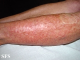 leiomyoma-multiple cutaneous leiomyomas