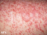 leiomyoma-multiple cutaneous leiomyomas