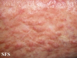 leiomyoma-multiple cutaneous leiomyomas