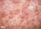 leiomyoma-multiple cutaneous leiomyomas