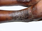 eczema microbic