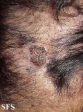 carcinoma-verrucous carcinoma