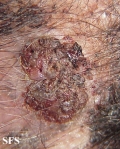 carcinoma-verrucous carcinoma