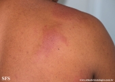 urticaria