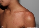 urticaria