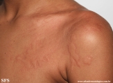 urticaria