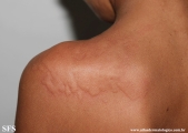urticaria
