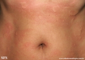 urticaria