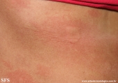 urticaria