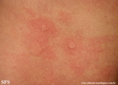 urticaria