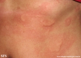 urticaria