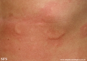 urticaria