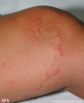 urticaria