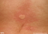 urticaria
