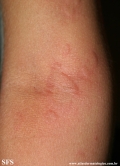 urticaria