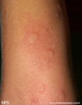 urticaria