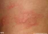 urticaria