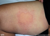 urticaria