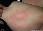 urticaria