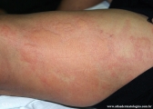 urticaria