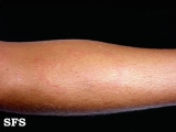 urticaria