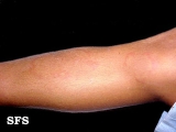urticaria