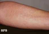 urticaria
