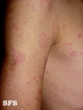 urticaria