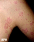 urticaria
